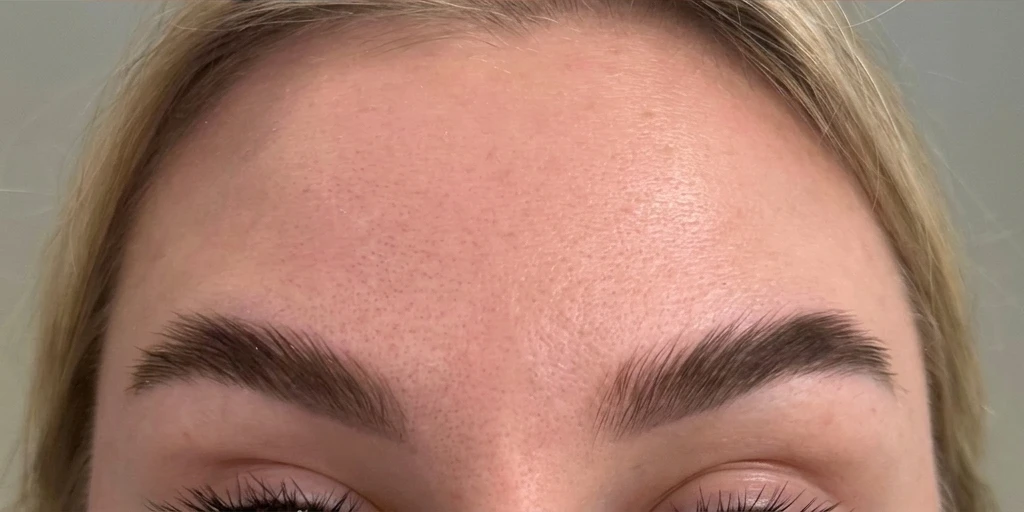 After — Softer lines, natural expression