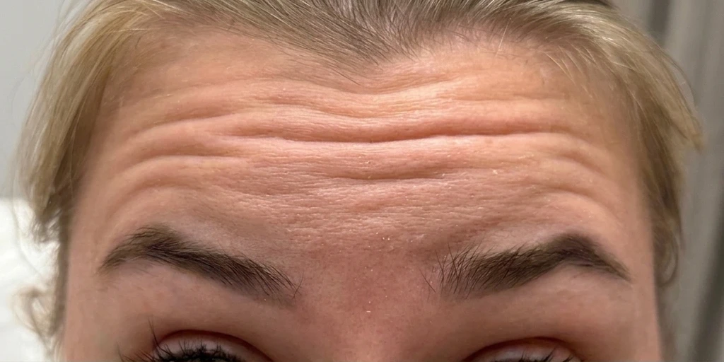 Before — Softer lines, natural expression