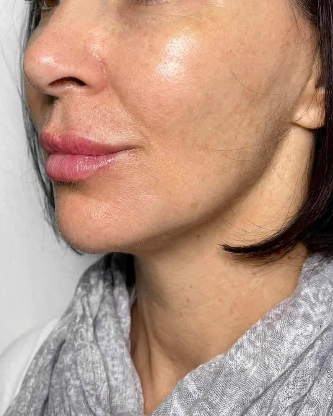 After — A year of facial balancing