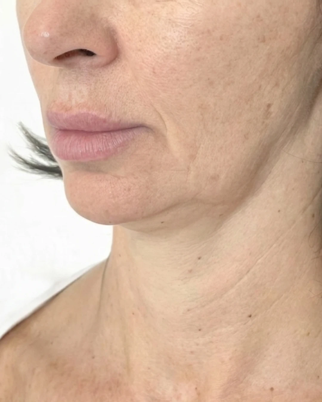 Before — A year of facial balancing